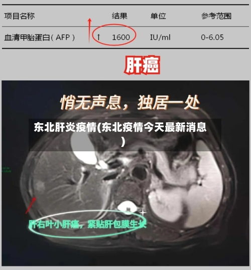 东北肝炎疫情(东北疫情今天最新消息)
