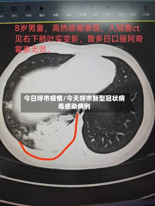 今日呼市疫情/今天呼市新型冠状病毒感染病例