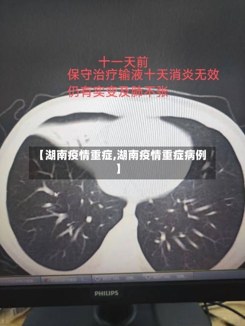 【湖南疫情重症,湖南疫情重症病例】